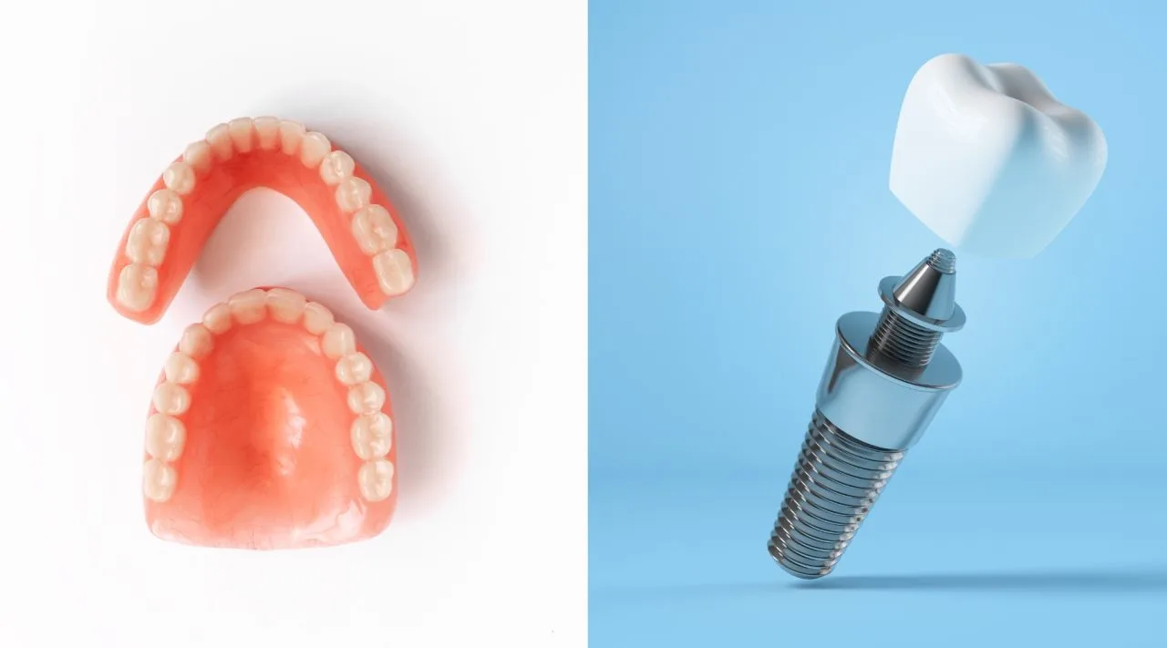 Sunt implanturile dentare mai bune decât protezele dentare?