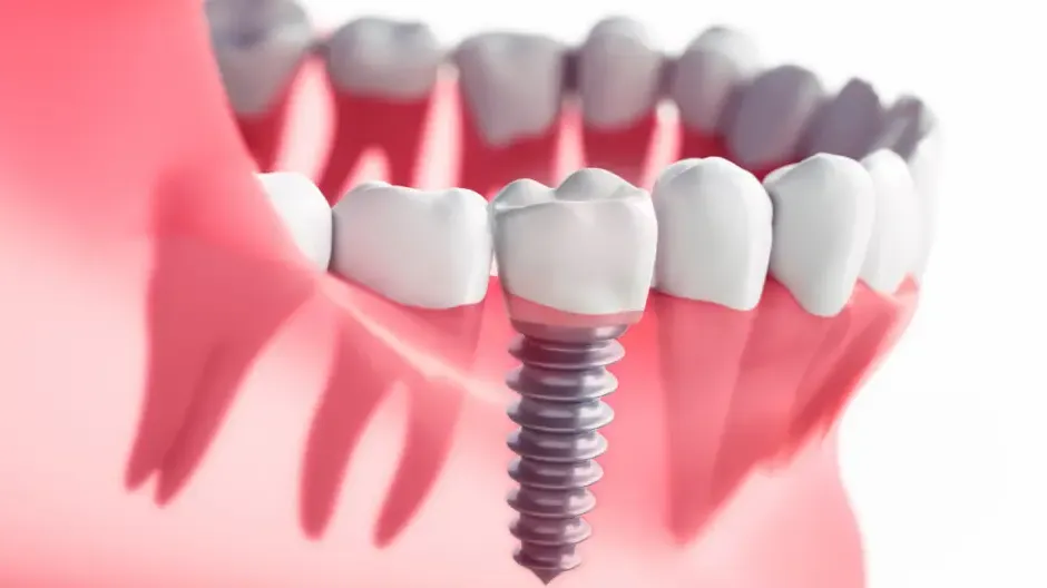 Care este rata de succes a implanturilor dentare?
